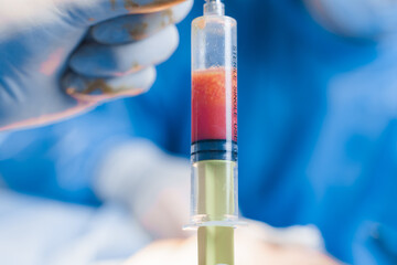 Human fat in a syringe close-up. Liposuction for lipofilling surgery operation. Plastic operation...