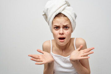 woman with a towel on her head on a light background and pimples on her face transitional age clean...