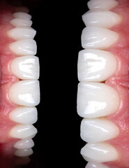 Perfect smile before and after bleaching procedure whitening of zircon arch ceramic prothesis...