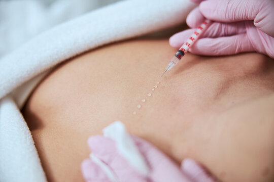 Woman being treated for the decolletage wrinkles