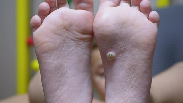 Callus and Wart Feet on Plantar Flat foot in Child. Flat feet. Close-Up