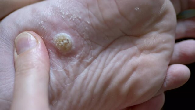 Callus and Wart on a Plantar Flat Foot in a Child. Inspection, Finger Pressing