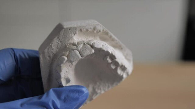 The plaster model of the maxilla in the hands of an orthodontist. orthodontist doctor in blue gloves indicates a problem with the teeth on the lower jaw plaster ingot. Close-up shot