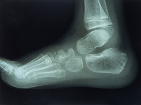 Foot and Toes. Human Leg in the X-ray image
