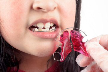 A dentist with gloves on his hands places braces on a girl's crooked teeth to correct them. Concept of oral health in childhood.