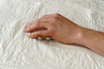 Fixateur externe nach einer OP am kleinen Finger der linken Hand nach einem komplizierten Bruch der...