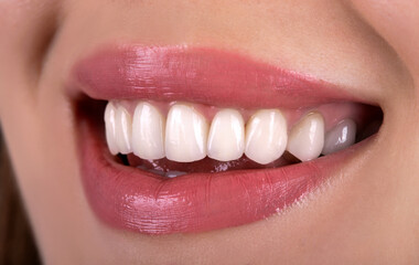 Perfect healthy teeth beautiful wide smile bleaching ceramic crowns whitening of young smiling attractive sexy lips woman. Dental zircon implants restoration treatment  Close Up surgery dentistry    
