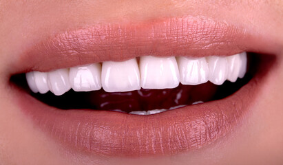 Perfect healthy teeth beautiful wide smile bleaching ceramic crowns whitening of young smiling...