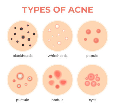 Acne types. Skin infection problem, pimples grade and type cyst, whitehead, blackheads, nodule and cystic. Dermis pore disease vector set