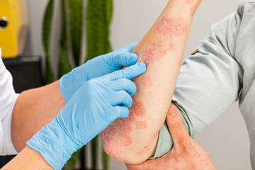 A dermatologist wearing gloves examines the skin of a sick patient. Examination and diagnosis of...