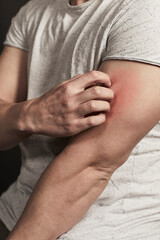 Mann kratzt sich am Arm