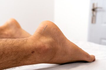 Man Receiving Acupuncture Treatment