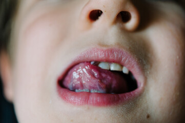 Close up of a young boy wiggling a loose tooth with his tongue - 398572466