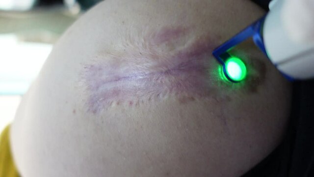 Flatten Keloids scar treatment with vbeam laser therapy and corticosteroid injection shots cosmetic patient in motion