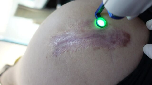 Flatten Keloids scar treatment with vbeam laser therapy and corticosteroid injection shots cosmetic patient in motion