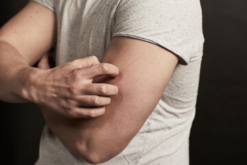 Mann mit Juckreiz kratzt sich am Oberarm