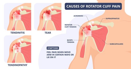 Rotator Cuff Disease sport pain torn tear arm treat frozen range of motion joint Chronic injuries heavy lifting sprain slap bicep problem degenerative bone tennis stiffness spur Physical therapy