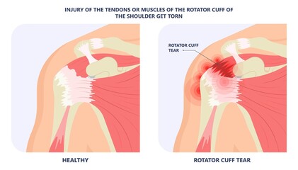 Rotator Cuff Disease sport pain torn tear arm treat frozen range of motion joint Chronic injuries heavy lifting sprain slap bicep problem degenerative bone tennis stiffness spur Physical therapy