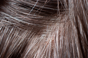 Macro photo of human hair with dandruff. Head wounds and itching, hair care, seborrheic treatment