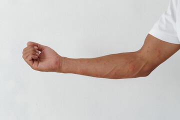 Skin rash, rashes caused by allergic reactions on arms.