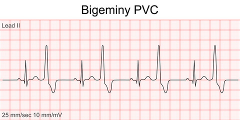 Electrocardiogram show ventricular fibrillation (VF) pattern. Cardiac fibrillation. Heart beat. CPR. ECG. EKG. Vita