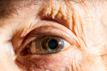 Image of an eye of an elderly woman with vision problems. in the eye the capillaries are...