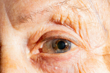 Image of an eye of an elderly woman with vision problems. in the eye the capillaries are distinguished