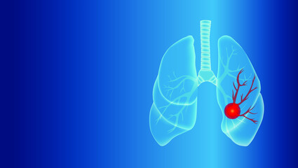 Human lungs with the disease.