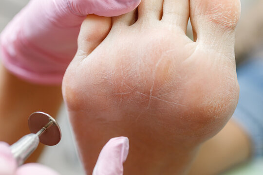 Women's feet and pedicure master. Professional hardware pedicure in a medical salon. Grinding rough skin on the foot with an abrasive disc. Visiting an orthopedic podiatrist.
