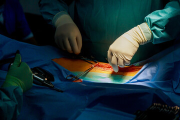 Deep incision with using electrical scalpel pencil to stop the bleeding in surgery of the leg...