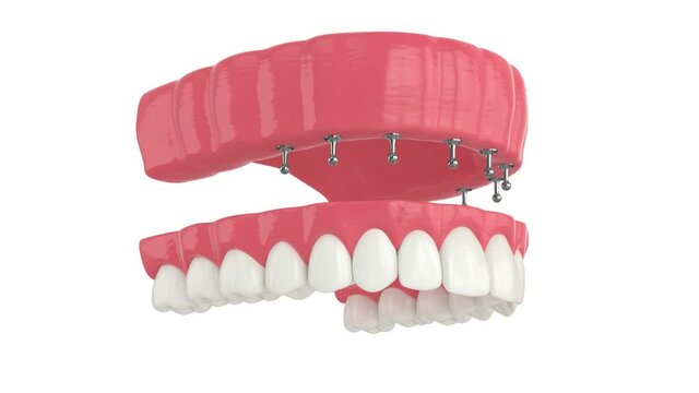 Removable snap-on full implant denture installation