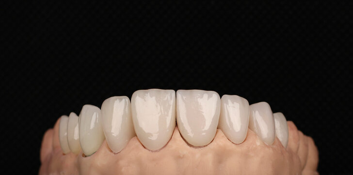 dental laminate veneers, zirconia ceramic crowns
3d printed model.