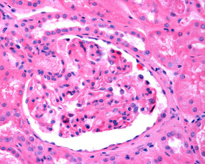 Kidney. Membranous glomerulonephritis