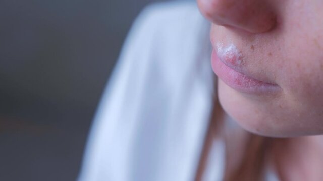 Herpes virus on human lips. Woman with herpes sore on lip mouth with ointment, closeup mouth. Process of dehydration during illness. Human papilloma virus, viral infection.