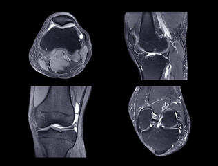 Magnetic resonance imaging or MRI knee comparison sagittal PDW and TIW view.