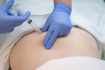Doctor makes injection of ozone gas in patient's woman back against stretches on ozone therapy, closeup view. Treatment, cure and remove of skin tags and stretches. Cosmetologist woman in gloves. - obrazy, fototapety, plakaty