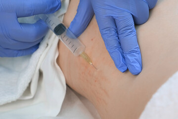 Doctor makes injection of ozone gas in patient woman on side of body on ozone therapy, closeup...