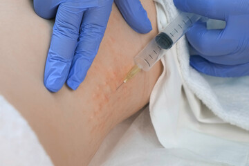 Doctor makes injection of ozone gas in patient woman on side of body on ozone therapy, closeup...