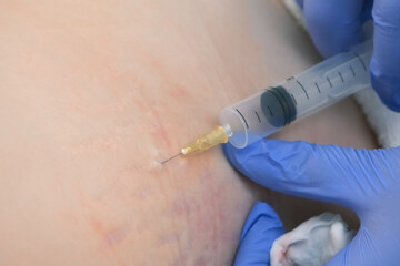 Doctor makes injection of ozone gas in patient woman on side of body on ozone therapy, closeup...