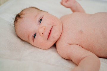 A baby with seborrheic dermatitis on his head rests on a white sheet. childcare.