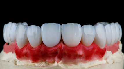 aesthetics of ceramic veneers of the upper jaw on a plaster model, photo against a black background © Dental Pro Content