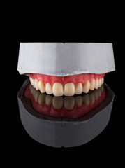 Complete maxillary denture – Wax-Up and Gingival Contouring