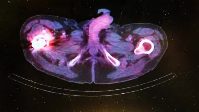 SPECT CT of the Pelvis Showing Bony Anatomy