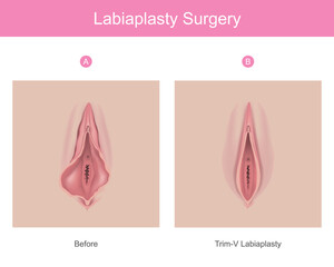 labiaplasty surgery. Illustration for medical use explain a procedure surgery to decrease the size of inner tissues the female genitalia.. - obrazy, fototapety, plakaty