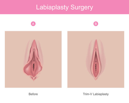 labiaplasty surgery. Illustration for medical use explain a procedure surgery to decrease the size of inner tissues the female genitalia..