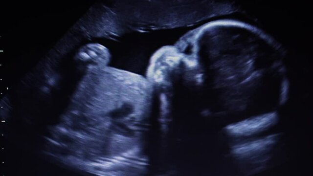 Footage Ultrasonography of third trimester pregnancy