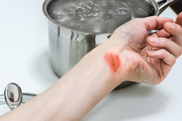 Woman’s hand with injuries near the pot with boiling water, burns of skin,  home accident concept, careless behavior with boiling water and hot steams, scalds on a skin