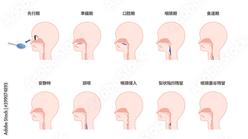 嚥下プロセスと誤嚥の所見のイラストセット Wall Mural ふわぷか