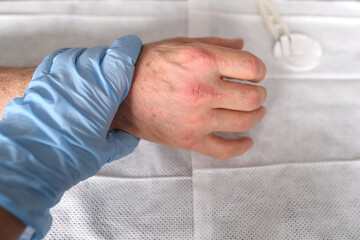 Close up of male hands with dry skin damage. nurse treats wounds. Dermatology concept