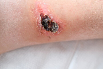 large healing wound from a severe burn on the leg of an adult male patient, redness, scarring of...